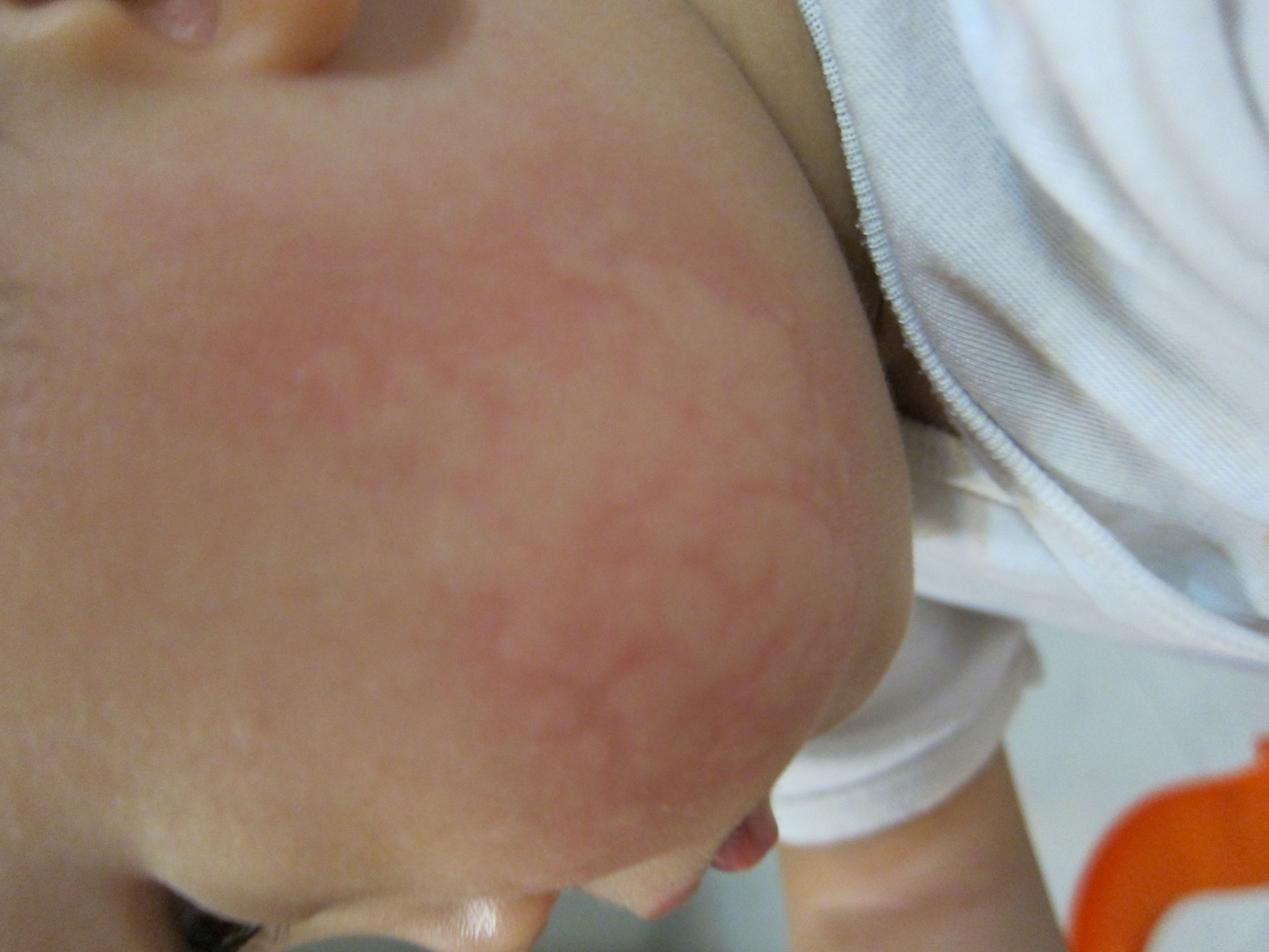 Pictures of Allergic Skin Diseases and Problems - Eczema